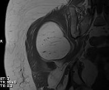 Lipoma Intramuscular0001